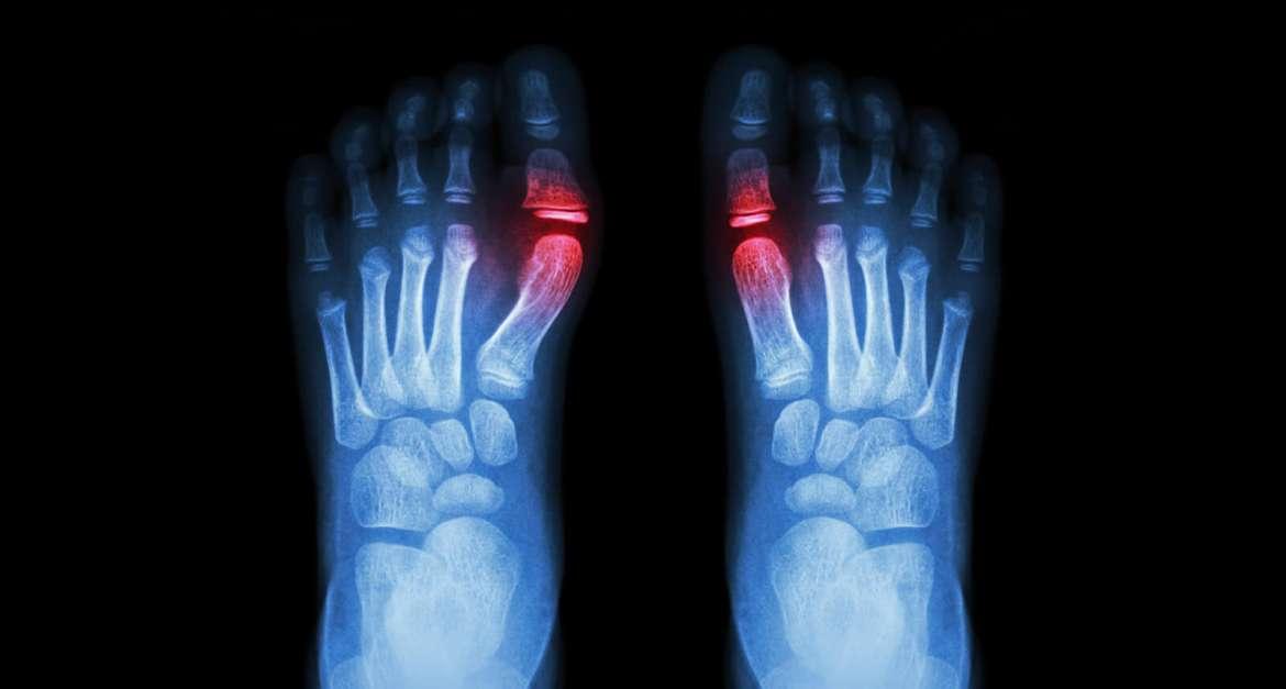 Halluks Valgus